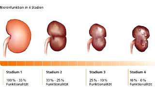 Glomerulonpehritis  Erkrankungen der Niere [upl. by Aynotal340]