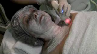 Tratamiento de radiofrecuencia facial [upl. by Gruver]